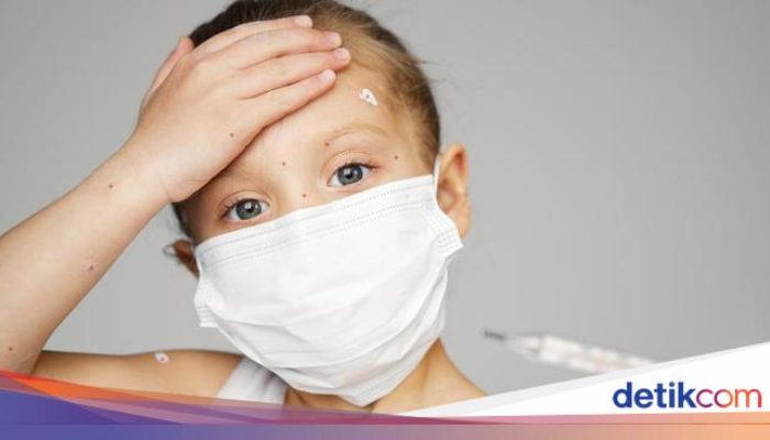 Wabah Flu Singapura Merebak di Kalbar: Ribuan Anak Terjangkit dalam Sebulan